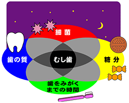 虫歯になる4条件